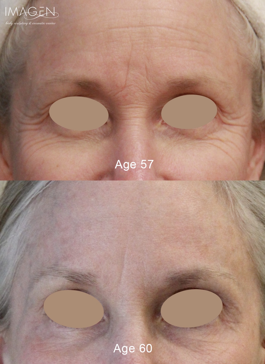Omaha Cosmetic Center - A woman's face with wrinkles before and after treatment