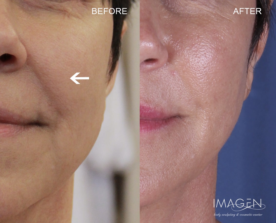 Omaha Cosmetic Center - Before and after photo of a woman's face