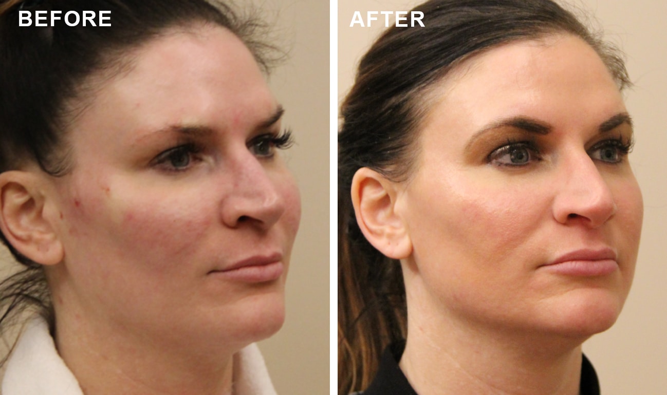 Omaha Cosmetic Center - Before and after photo of a woman's face