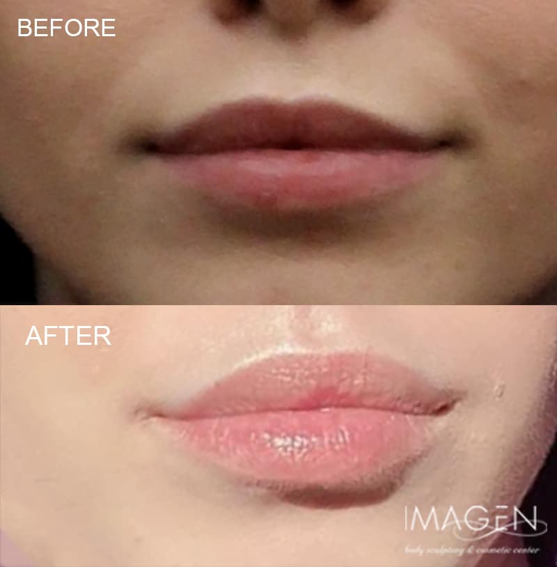Omaha Cosmetic Center - A woman's lips before and after lip injections