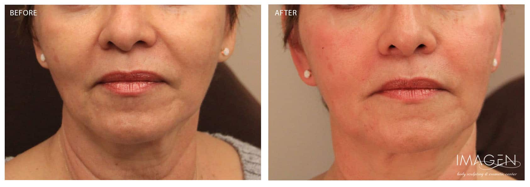 before and after dermal fillers omaha ne