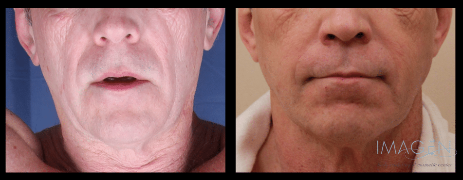 Omaha Cosmetic Center - A man's face before and after liposuction