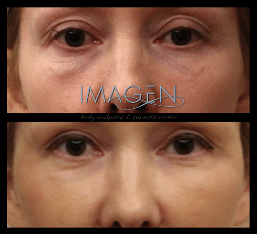 Omaha Cosmetic Center - Before and after images of a woman's eyelids