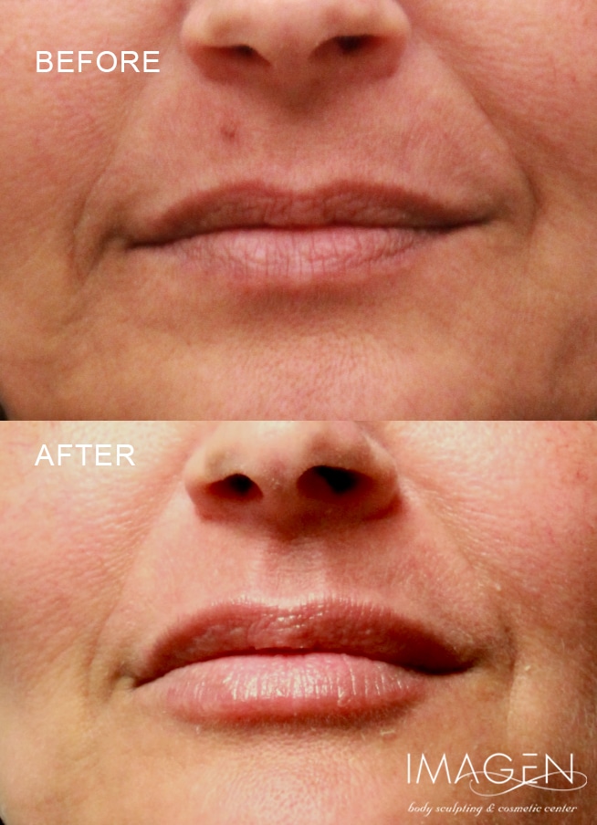 Omaha Cosmetic Center - Before and after images of a woman's lips