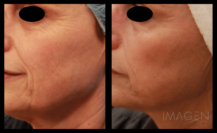 Omaha Cosmetic Center - Before and after photos of a woman with wrinkles