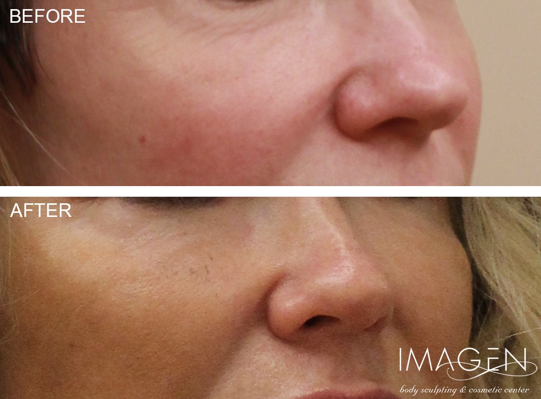 Omaha Cosmetic Center - Before and after photo of a woman's face