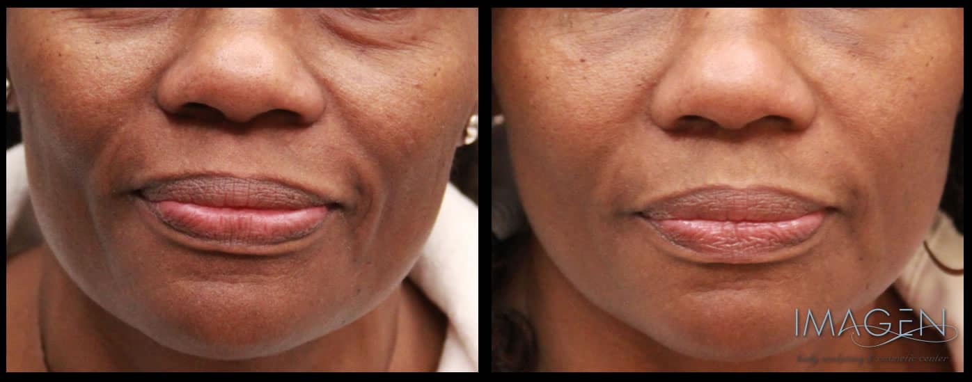 Omaha Cosmetic Center - Before and after photos of a woman's lips