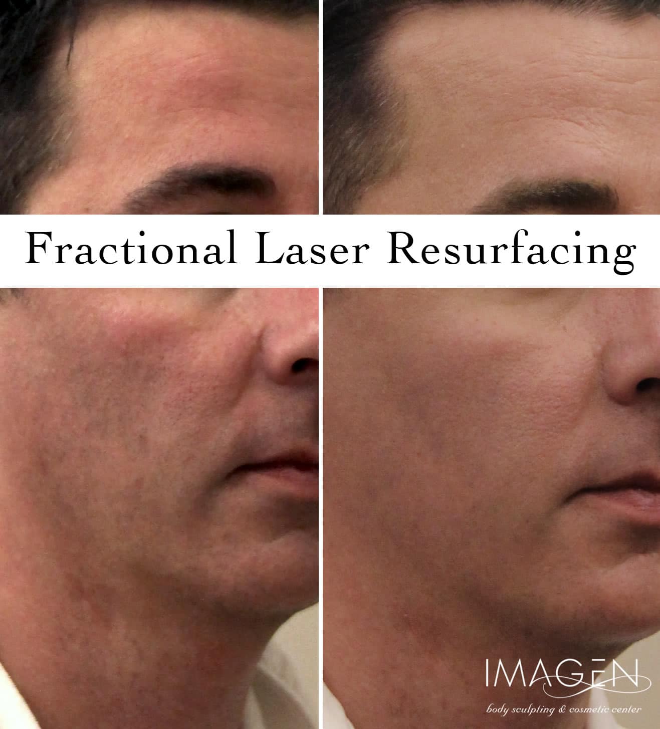 Omaha Cosmetic Center - Fractional laser resurfacing before and after