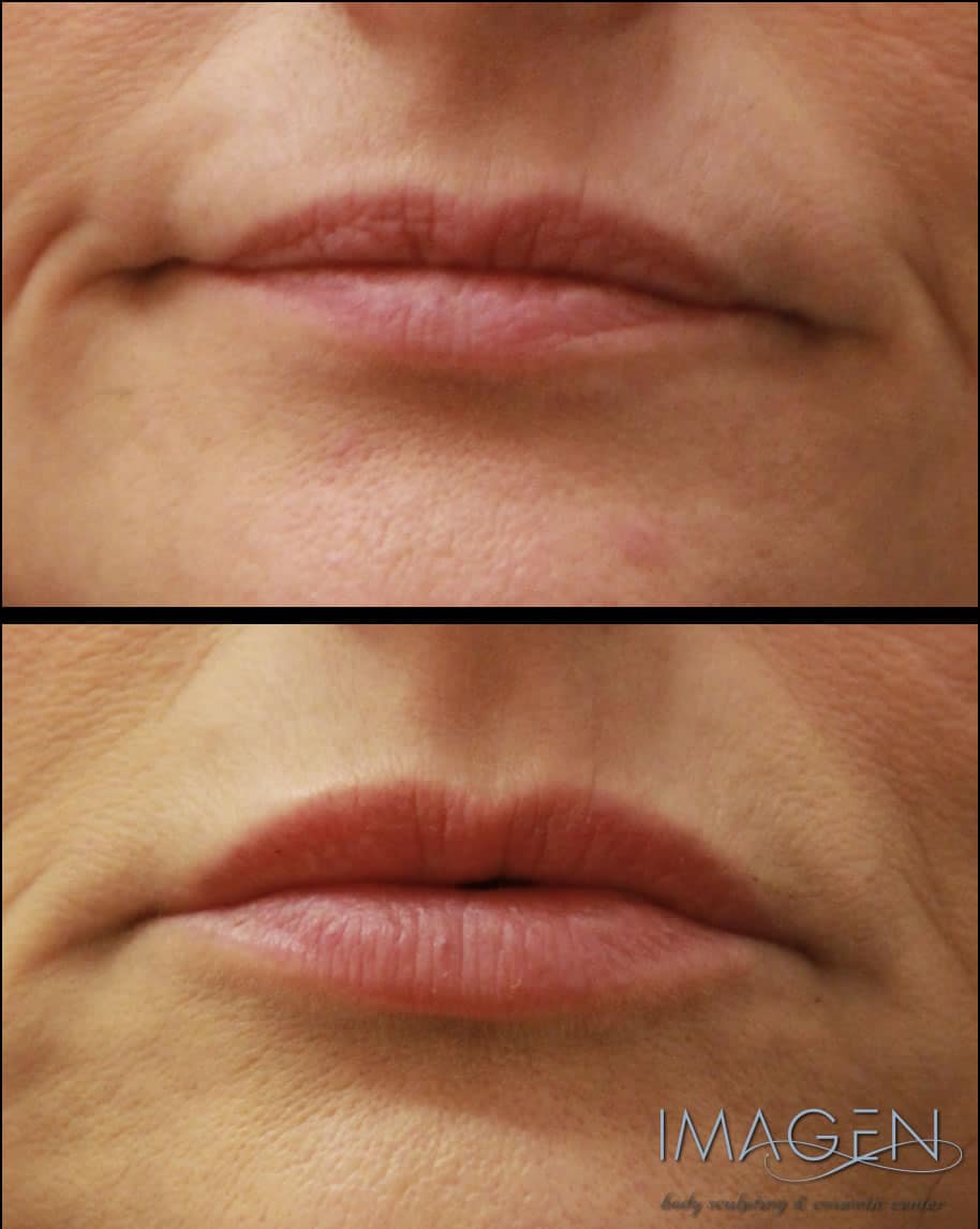 Omaha Cosmetic Center - A woman's lips before and after lip injections