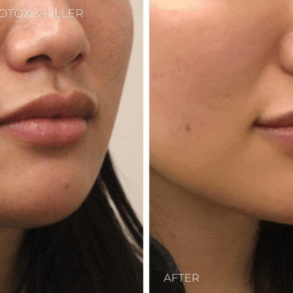 Before and after PRP injections, Botox/Dysport and dermal fillers omaha ne